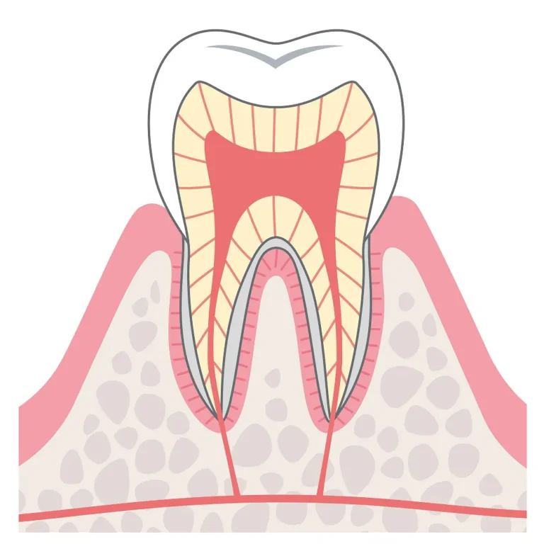 C0は、歯の成分が溶け出す「脱灰」と呼ばれる現象