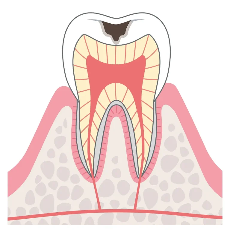 C2は、象牙質と呼ばれる歯質までむし歯が進行した状態