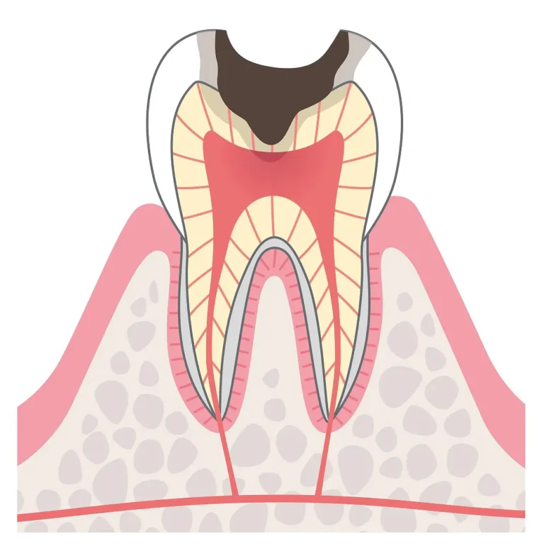 C3は、むし歯が神経に達した段階