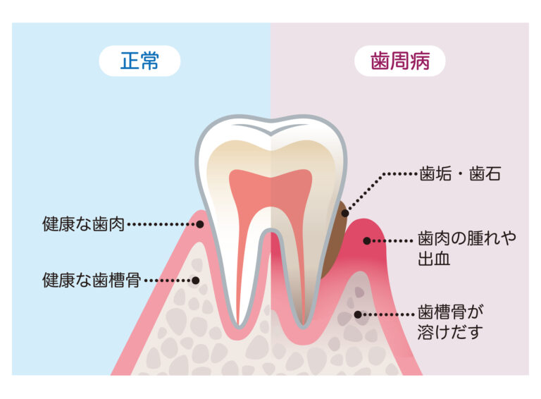 歯周病は、最も深刻なのは歯を支える歯槽骨という骨を溶かしてしまう症状です